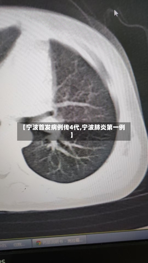 【宁波首发病例传4代,宁波肺炎第一例】