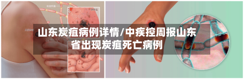 山东炭疽病例详情/中疾控周报山东省出现炭疽死亡病例-第3张图片