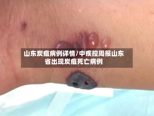 山东炭疽病例详情/中疾控周报山东省出现炭疽死亡病例