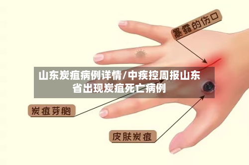 山东炭疽病例详情/中疾控周报山东省出现炭疽死亡病例-第2张图片
