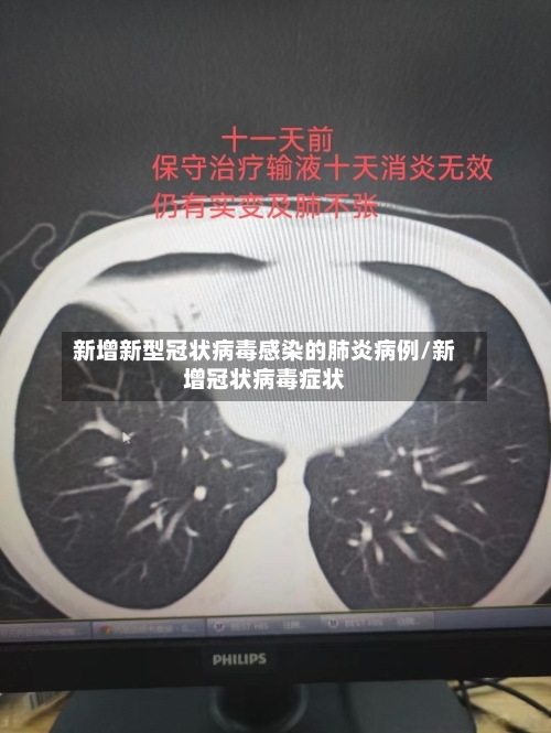 新增新型冠状病毒感染的肺炎病例/新增冠状病毒症状